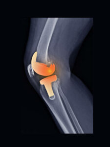 film X-ray total knee replacement